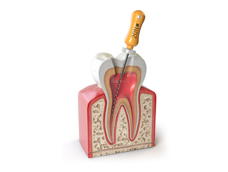 Root Canal Step by Step procedure