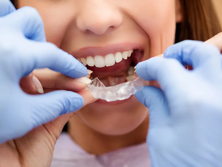 How much is invisalign price