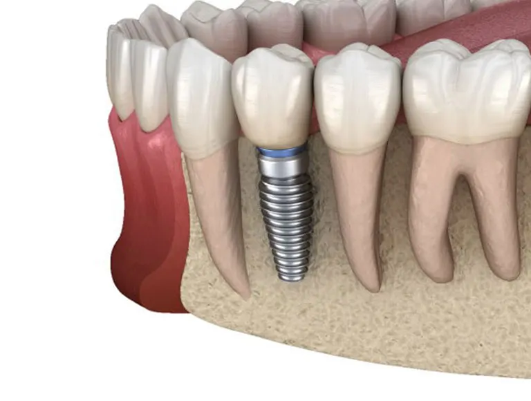 Does Dental Insurance Cover Dental Implant Surgery?