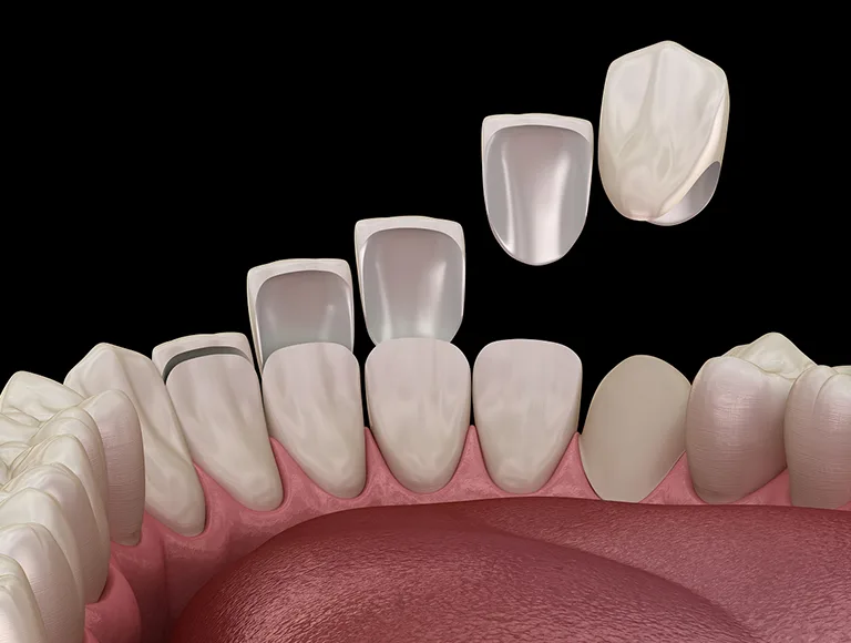 Partial dentures