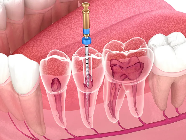 Root canal cost in Fountain Valley