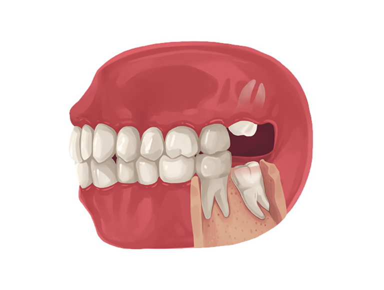 Wisdom Tooth Extraction in Costa Mesa Community