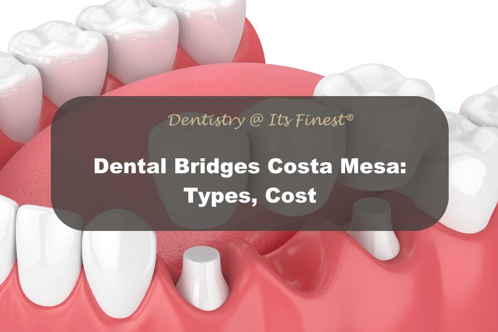 Dental Bridges Costa Mesa