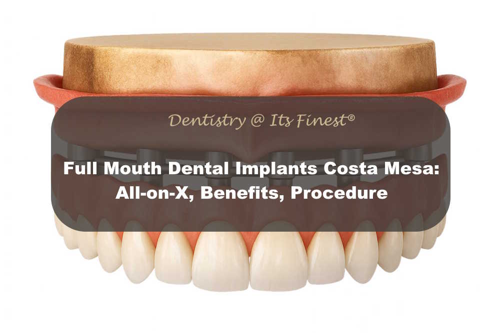 Full Mouth Dental Implants Costa Mesa