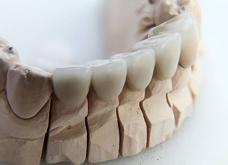 Prezzo delle corone dentali 