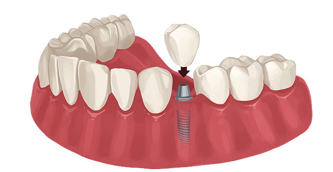 Технология зубного имплантирования