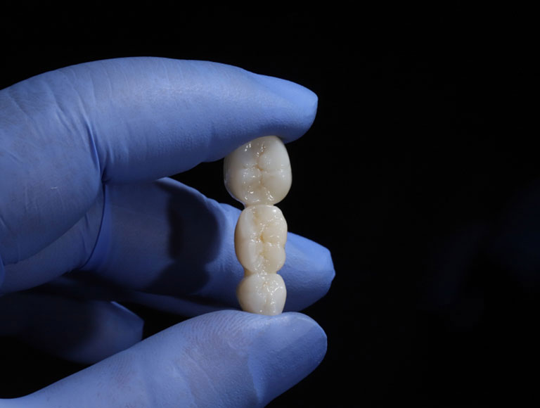 Costa Mesa, Dental Bridges
