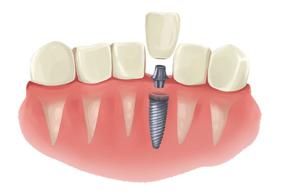 Dental implant cost  How much are Dental implants  Single tooth