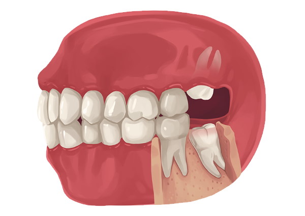 Costa Mesa Wisdom Teeth Removal - Costa Mesa CA Oral Surgery Impacted  Molars | Dentistry At Its Finest